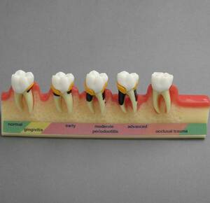cc高級歯列模型　歯周病進行段階 模型 歯槽膿漏 歯周炎 ペリオ
