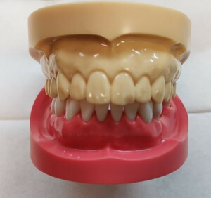 歯科　義歯　サンプル　模型　入れ歯