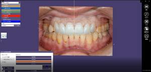 歯科　歯科技工　デジタルデンタルパーツ　スマイルデザイン用　カラーテンプレート＋ラインテンプレート＋ゴールデンプロポーションガイド