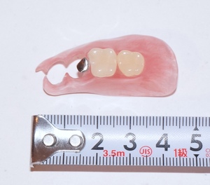 歯科 義歯 スマイルデンチャー ノンクラスプデンチャー サンプル 模型 見本 入れ歯 補綴 デンチャー 説明 技工 自費 資料 インプラント