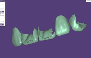 歯科　歯科技工　デジタルモックアップシェル ダイレクトボンディングガイド　デジタルワーク　meshmixer mp4動画
