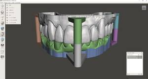 歯科　歯科技工 Toriosデータから中空モデルの製作手順書/PDF .dcm IOS　3Dプリンティング Meshmixer