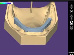 歯科　歯科技工　インプラントバー構造データ作成手順　mp4動画　