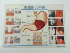 【プラ板1枚】 胃潰瘍の分類・慢性胃炎の分類 監修・東京医科大学第四内科 26cm×36cm 発行年不明 医学 医療 治療 病院 医者