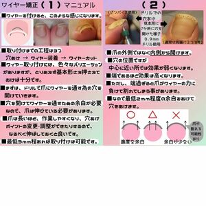 【巻き爪ケア】セルフワイヤーマニュアル