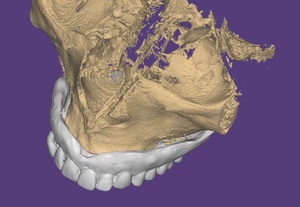 歯科　歯科技工　ダイコムデータから骨や歯のデータを抜き出す手順動画　mp4 CBCT 